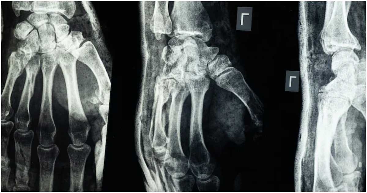 ভাঙা হাড় জোড়া লাগানোর আঠা উদ্ভাবন করেছেন চীনা গবেষকরা। ছবি: এনডিটিভি